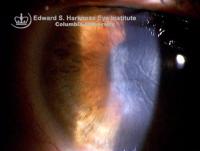 Corneal edema with Descemet's folds after phacoemulsification surgery